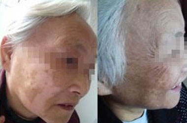 白癜风会传染吗？