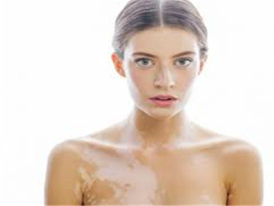 白癜风会不会遗传？