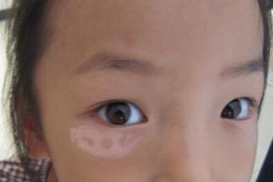 儿童白癜风的病因是什么?