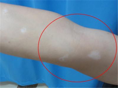 出现白癜风的原因主要有哪些