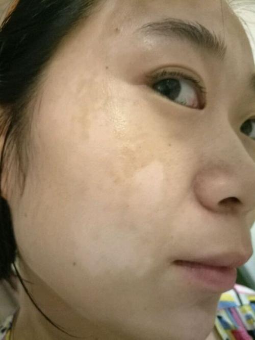 白癜风有哪些危害？