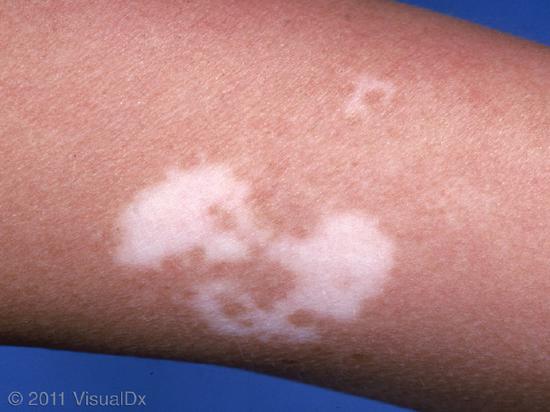 白癜风腿上有白斑是怎么回事