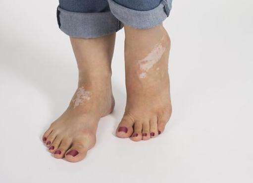 儿童患白癜风都有哪些原因?