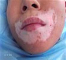 白癜风会隔代遗传吗？