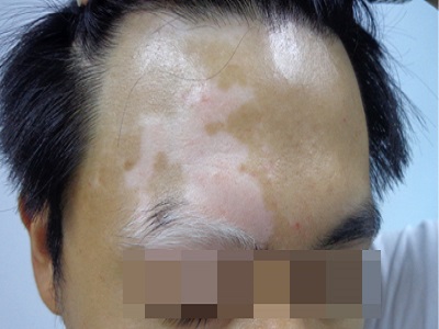头部白癜风不及时治疗的危害