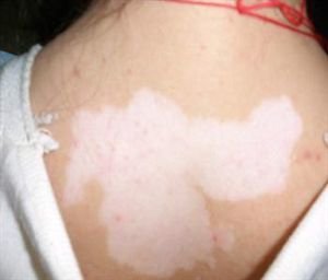 女性白癜风的病因有哪些？ 