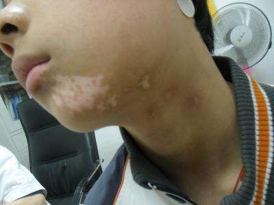 青少年病发白癜风的原因有哪些?