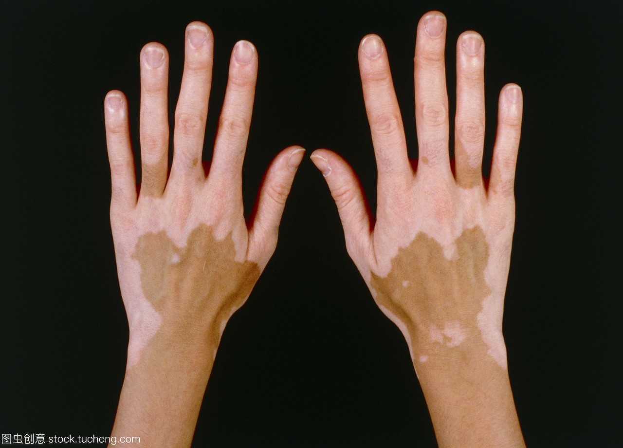 白癜风患者体内黑色素为什么流失?