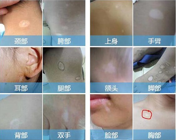 白癜风的诱发因素有哪些？ 